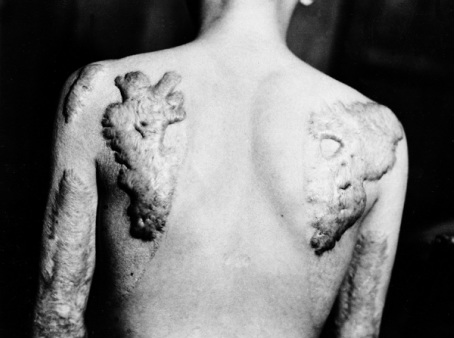keloid scars on a humans back